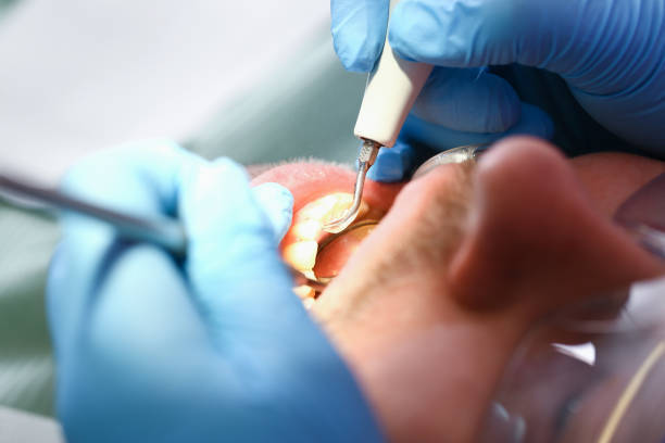 Best Dental Abscess Treatment in USA